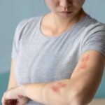 Shingles in Adults: Recognizing Early Signs