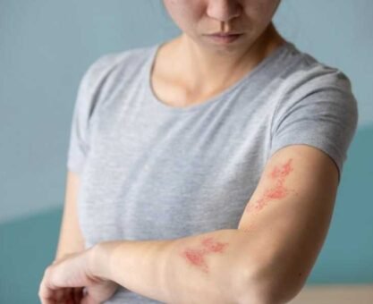 Shingles in Adults: Recognizing Early Signs