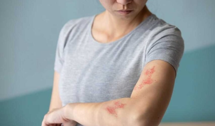 Shingles in Adults: Recognizing Early Signs