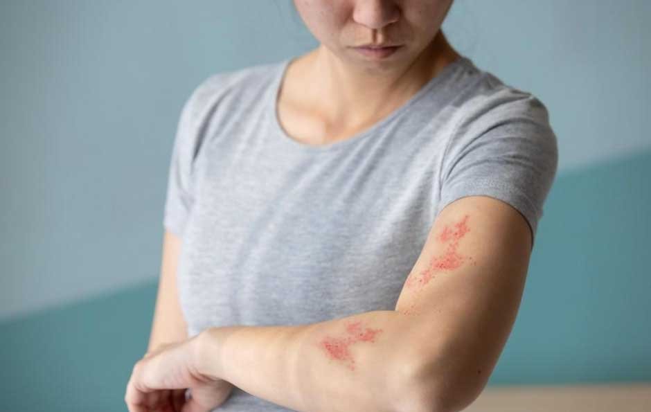 Shingles in Adults: Recognizing Early Signs