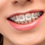 How Straightening Teeth Aligners Work and Why They're So Popular