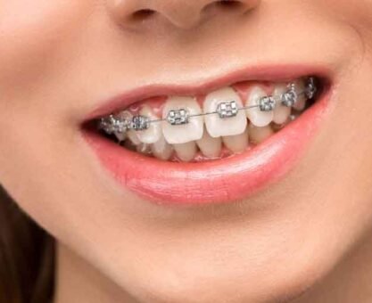 How Straightening Teeth Aligners Work and Why They're So Popular