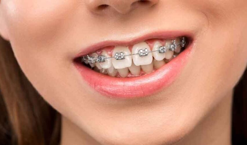 How Straightening Teeth Aligners Work and Why They're So Popular