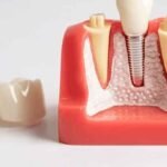 Expert Cosmetic Dental Implants with Personalized Care