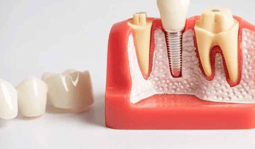 Expert Cosmetic Dental Implants with Personalized Care