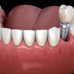Why Dental Implants Are Worth Considering (Even If You’re Still Unsure)