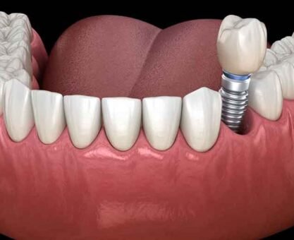 Why Dental Implants Are Worth Considering (Even If You’re Still Unsure)